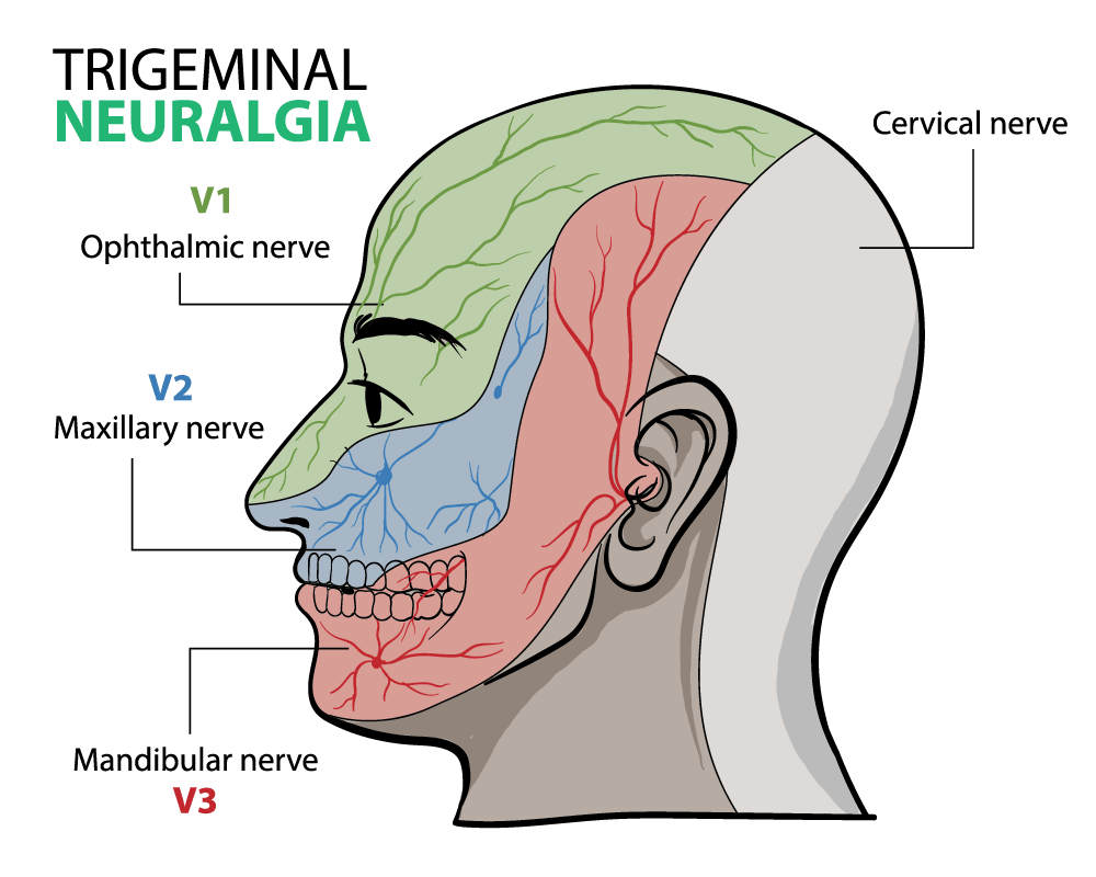 illustration of Trigeminal neuralgia infographic, a chronic pain condition that affects the trigeminal nerve