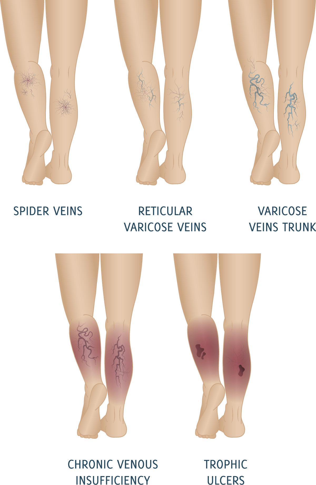 Graphic of 5 Stages of Varicose Veins