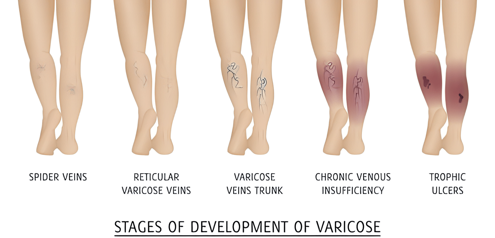 Beyond the Bulges: What You Need to Know About Chronic Venous Insufficiency