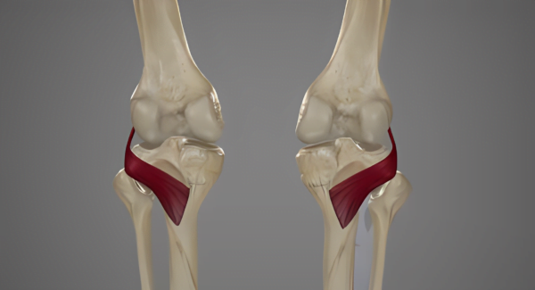 Osteoarthritis & Knee Pain: Can Strengthening the Popliteus Be the ...