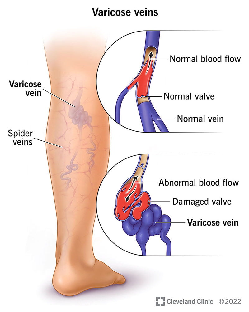 Understanding Varicose Veins
