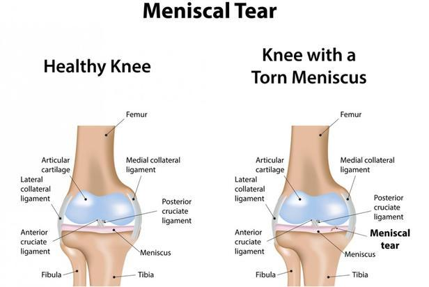 Why Does My Knee Click? It Could Be a Meniscus Tear