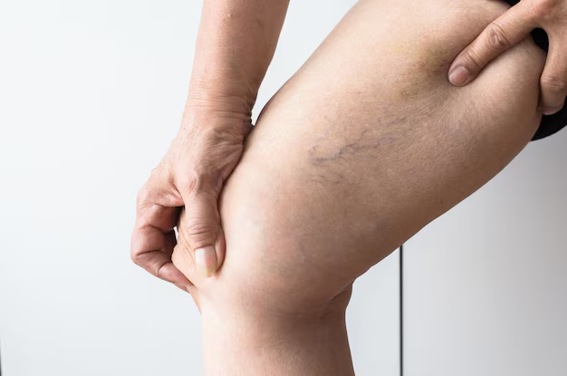 The Link Between Obesity and Varicose Veins