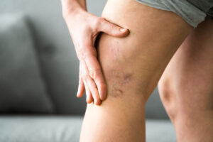 Close-up of varicose and spider veins on leg