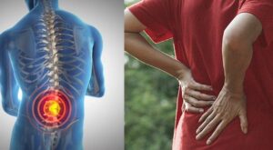 Lower back pain caused by sciatica nerve compression