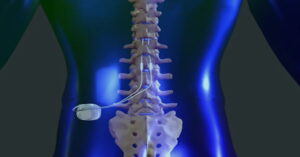 Implanted spinal cord stimulation device for chronic back pain relief at MVM Health clinic