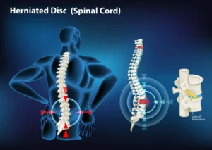3D illustration showing the Herniated Disc-Free Life!