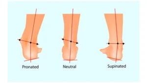 Taking a Stand Against Collapsed Ankles