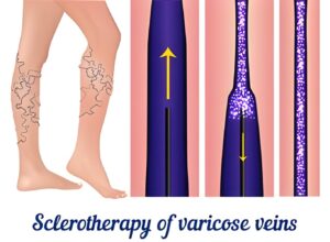 highlighting the micro foam sclerotherapy of varicose veins