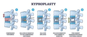 Kyphoplasty as treatment solution for Osteoporosis related vertebral compression fractures