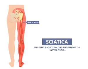 Showing the Sciatica Pain
