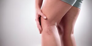 woman is suffering form Varicose Veins