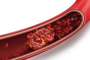 3D illustration of a blood clot forming inside a blood vessel with red blood cells