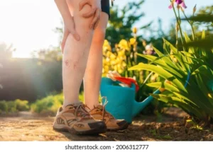 woman is suffering from Varicose Veins