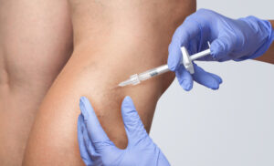 woman is get treatment of Veins at MVM