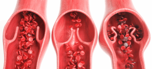 The different types of the risk of weak leg veins