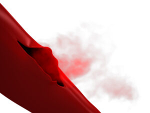 Potential consequences of burst varicose veins