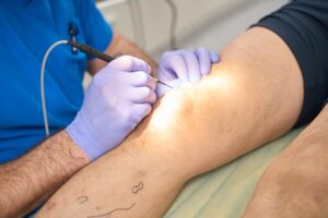 doctor is give the treatment of Vein