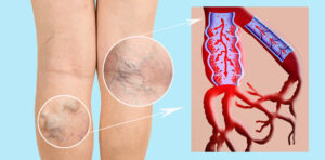 highlighting the issue of Varicose Veins