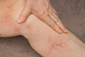 Woman is holding her legs as she is suffering form Varicose Veins