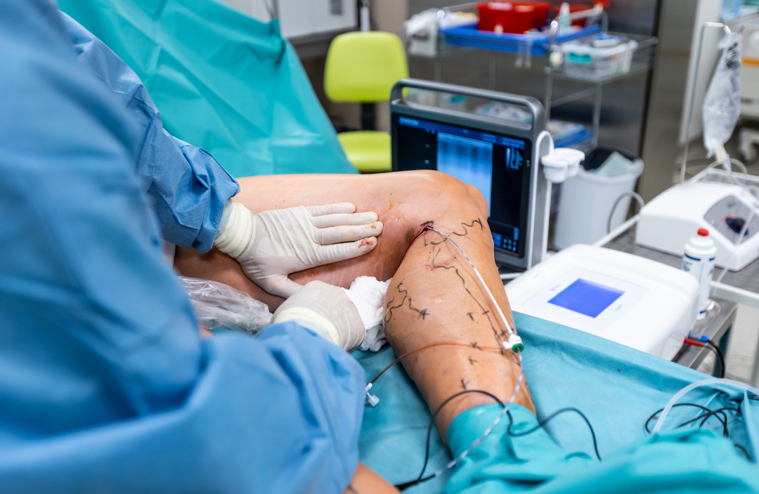 Recovery and Aftercare Following Varicose Vein Procedures