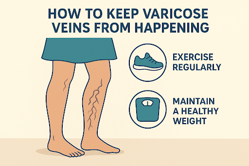 varicose veins