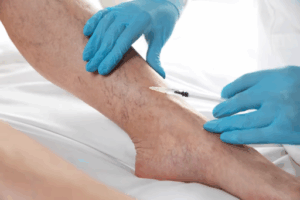 varicose vein