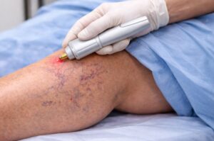 External-laser-for-spider-veins