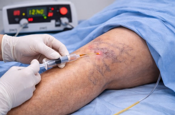 Spider Veins