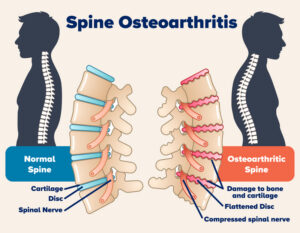 Minimally Invasive Spine Care