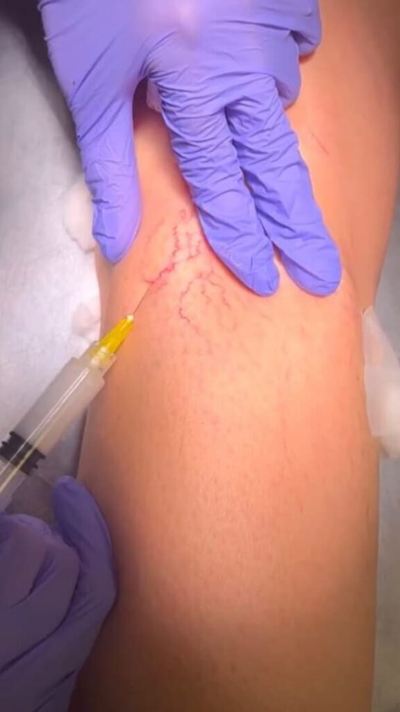 Vein Health