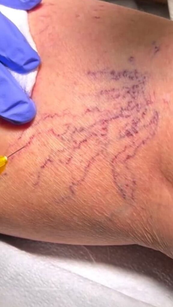 Vein Health