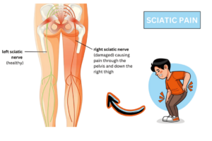 sciatica pain treatment