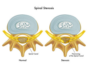 Neck Pain Treatment