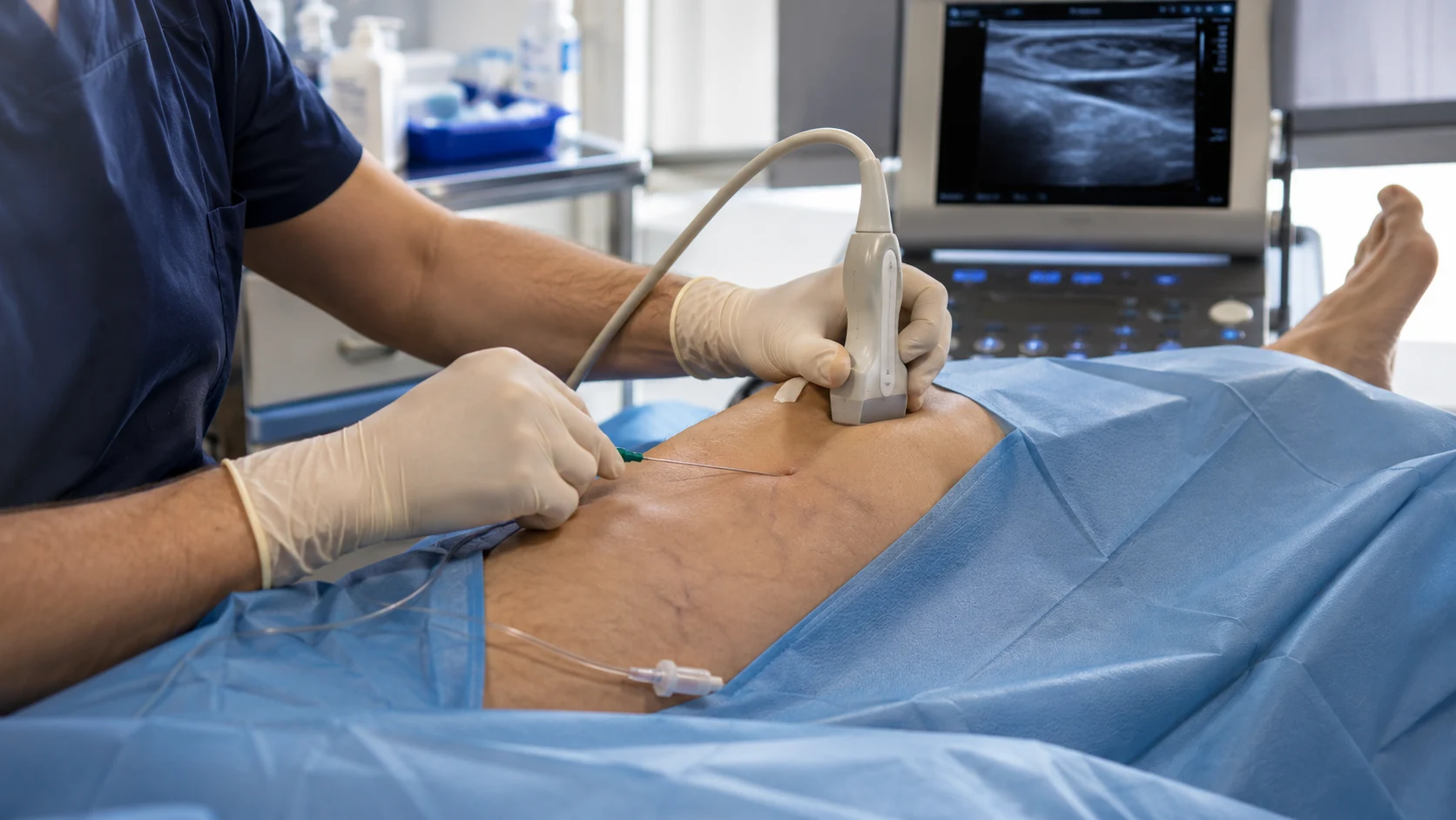 radiofrequency ablation Reading PA,radiofrequency ablation,Vein Treatment,varicose veins,MVM Health