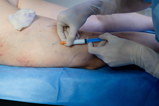 Sclerotherapy