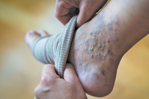 Causes Varicose Veins