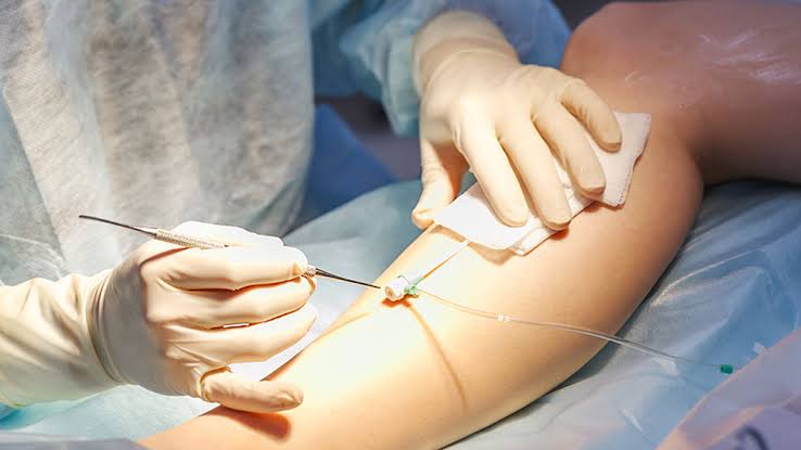Varicose Vein