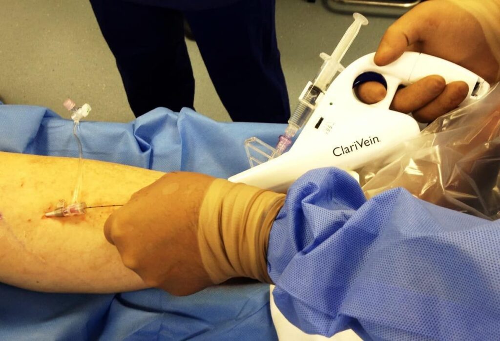 Varicose Vein