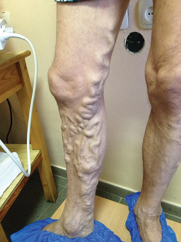 Vein Treatment,Vein Treatment Options
