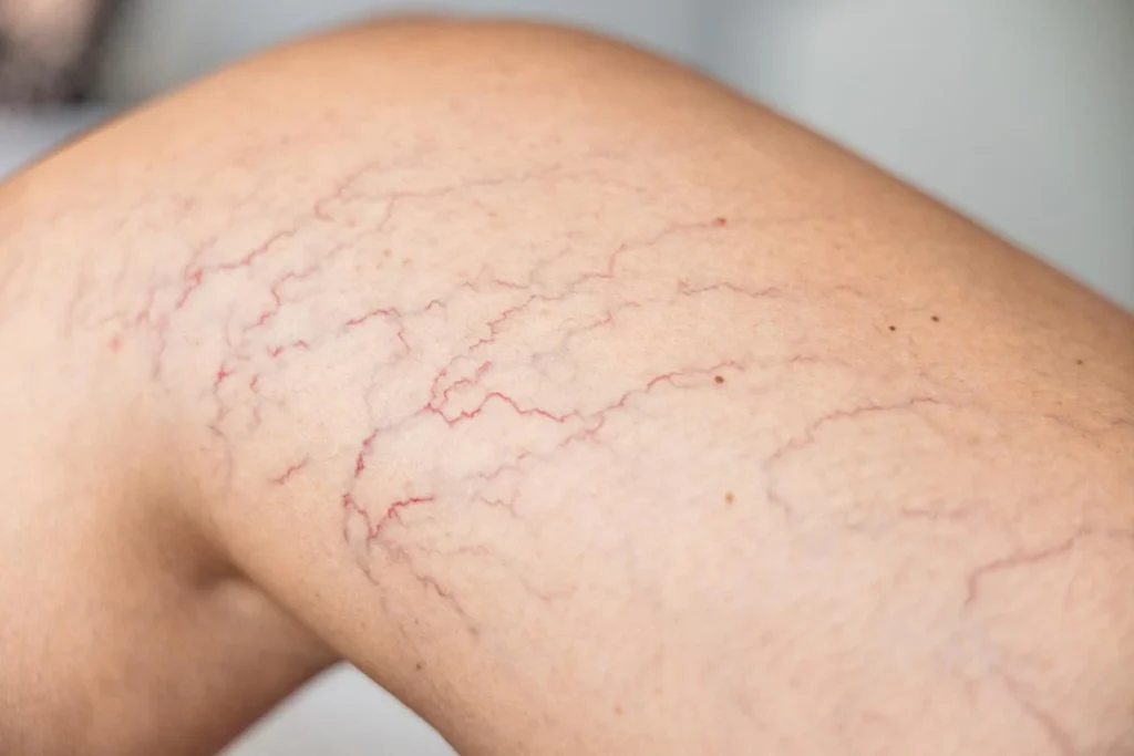 Vein Treatment,Vein Treatment Options