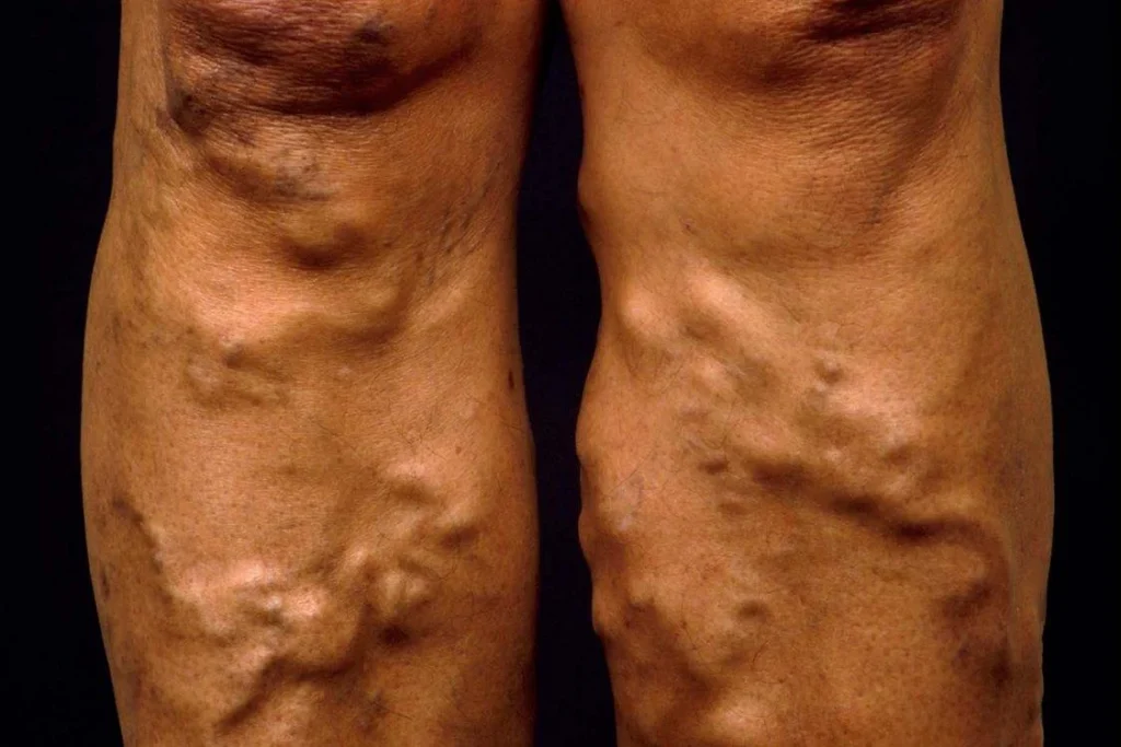 Vein Treatment,Vein Treatment Options