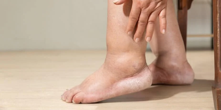 Varicose Vein