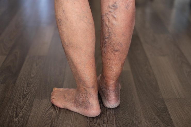 Leg Heaviness