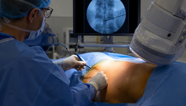 epidural injection