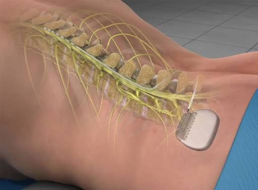 epidural injection