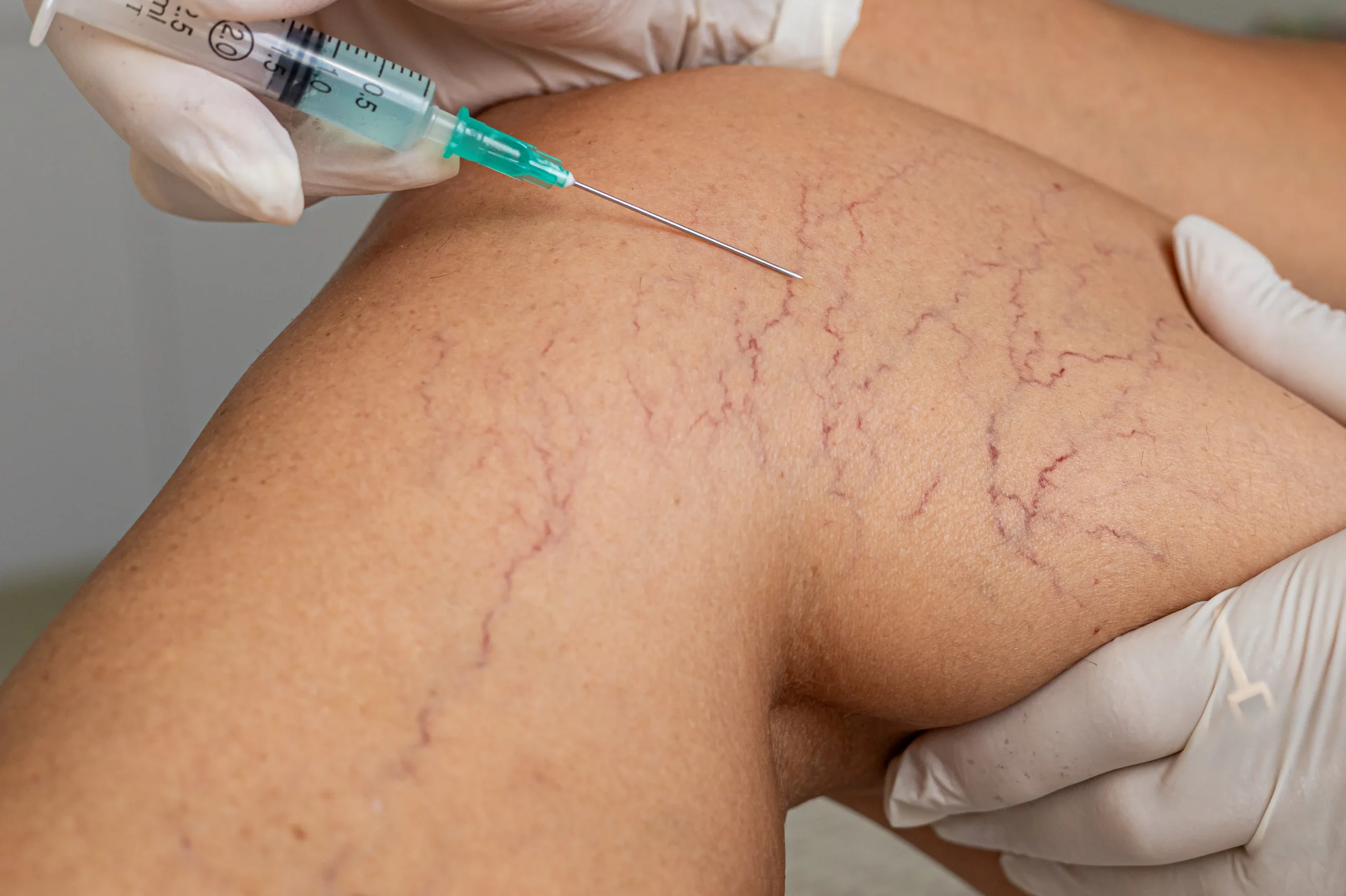 Vein Treatment,Vein Treatment Options